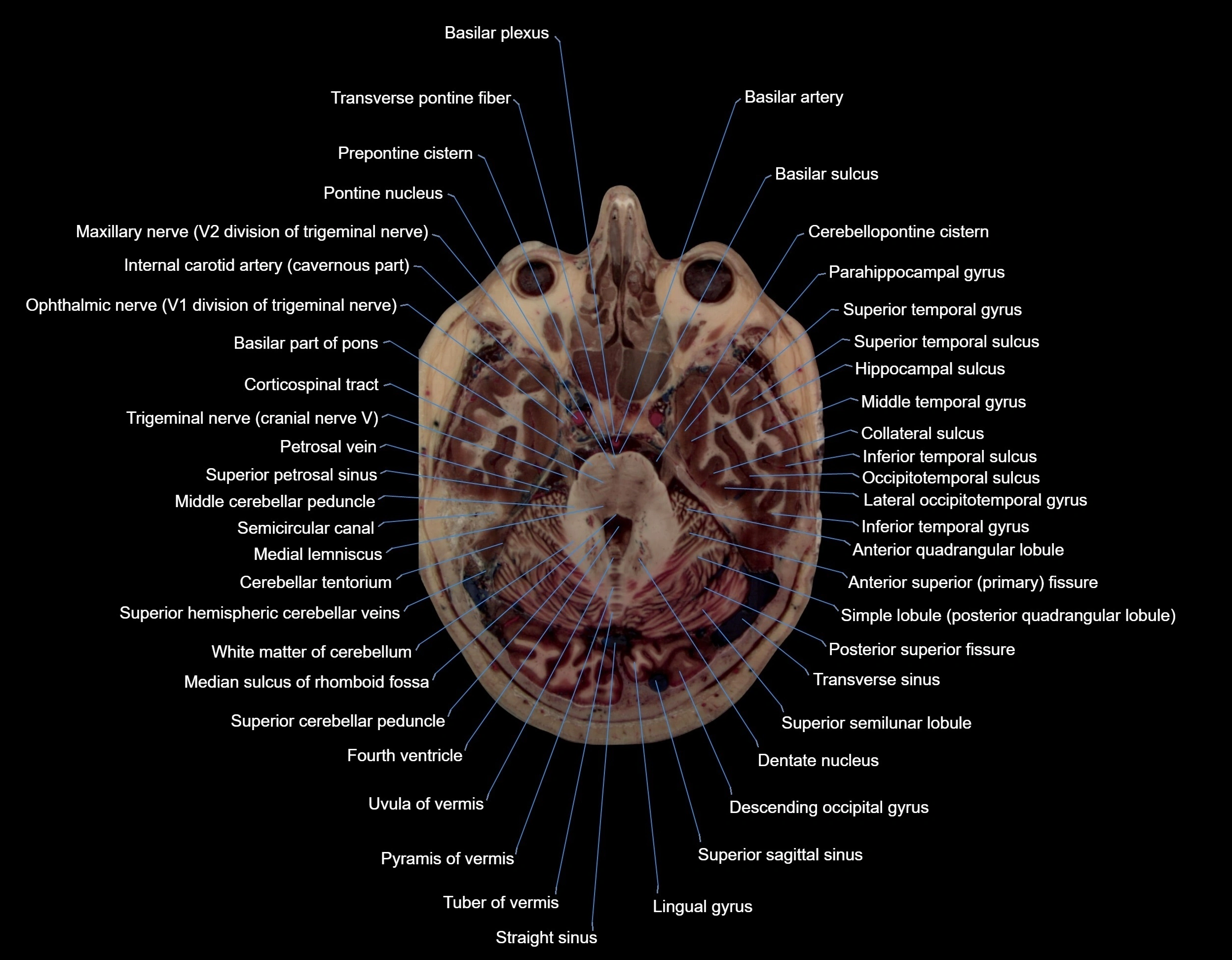 MRI Brain axial cross sectional radiology anatomy 3T image  -img-000024.webp